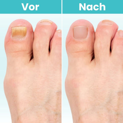 FungiClear Pro™ - Laser-Nagelpilz-Behandlung Gerät